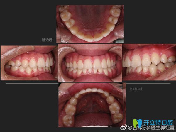 牙齒擁擠矯正后效果圖