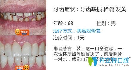 南京博韻口腔周光正靠譜嗎？美容冠修復(fù)案例公布