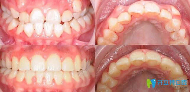 極光口腔美式兒童頜面管理，面型干預效果前后對比