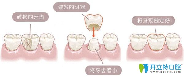 美容冠矯正好還是牙套矯正好