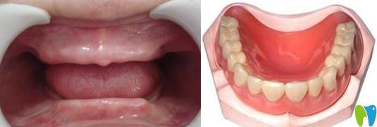 全口牙缺失怎么辦及做種植牙需要種幾顆