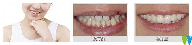 深圳正夫口腔張運(yùn)發(fā)怎么樣？真人牙齒種植修復(fù)案例效果來(lái)驗(yàn)證