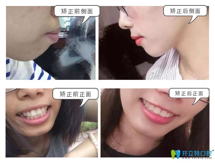 骨性齙牙矯正前后效果對比照