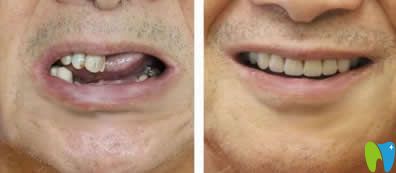 中山好民生口腔黎洪強(qiáng)醫(yī)生多顆牙種植效果