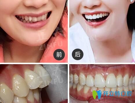 深圳正夫口腔正畸怎么樣?看多組正夫口腔牙齒矯正評價