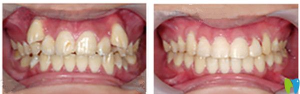 吉林愛齒口腔郭旭磊牙齒矯正前后效果圖
