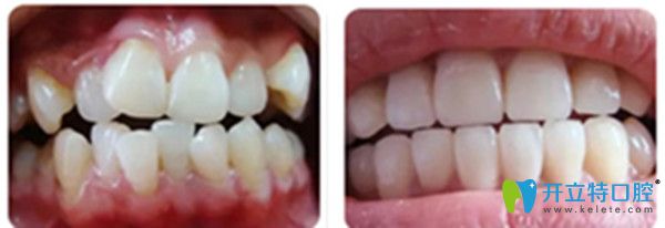 吉林愛齒口腔牙齒矯正對比圖