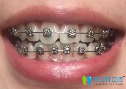 我在昆明王巍口腔矯正戴牙套第9個月