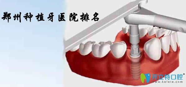 通過鄭州種植牙醫(yī)院排名及價格揭曉鄭州種植牙哪家醫(yī)院好
