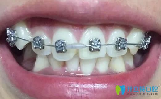我在昆明王巍口腔做金屬矯正戴牙套第3個月