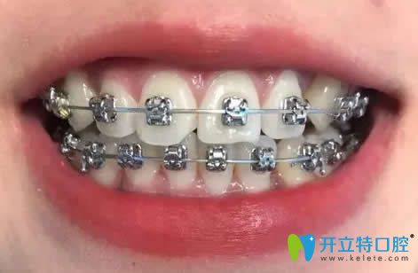 我在昆明王巍口腔做牙齒矯正15個月