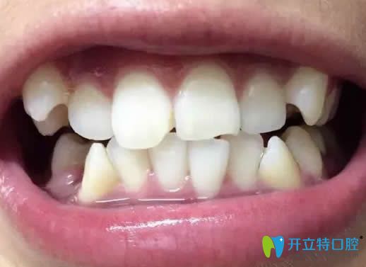 我在昆明王巍口腔做牙齒矯正前的照片