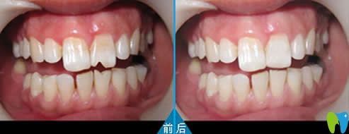 門牙磨損貼面修復效果