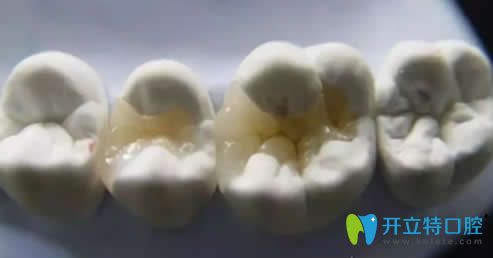 后牙磨損修復方法