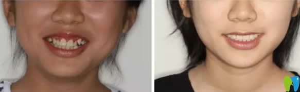 安植雅口腔隱形牙齒矯正前后對(duì)比圖