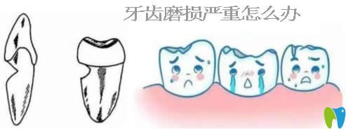 深挖牙齒磨損的原因,了解牙齒磨損會自動修復嗎及如何修復