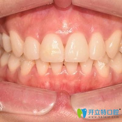 即刻種植牙前后對比照