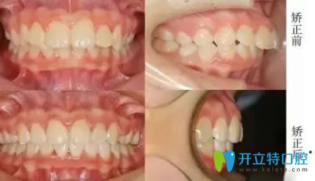 南昌安植雅口腔陳威宏博士齙牙隱形矯正案例