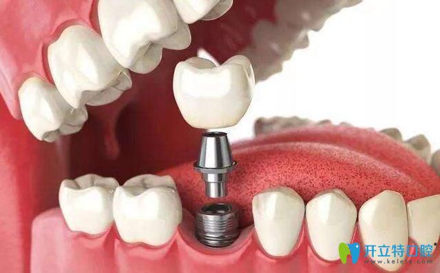 牙齒缺失不僅能做烤瓷牙、全瓷牙等等，還可以做種植牙