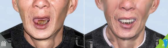 南昌安植雅口腔廖偉民全口種植牙案例