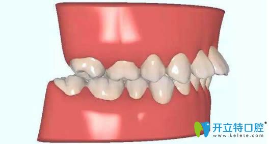 正畸醫(yī)生分享前牙深覆蓋矯正的價(jià)格需要多少錢(qián)？