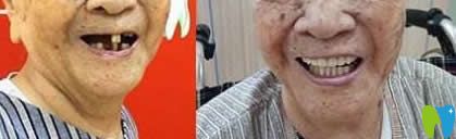 南昌安植雅口腔路文碩醫(yī)生全口種植牙效果