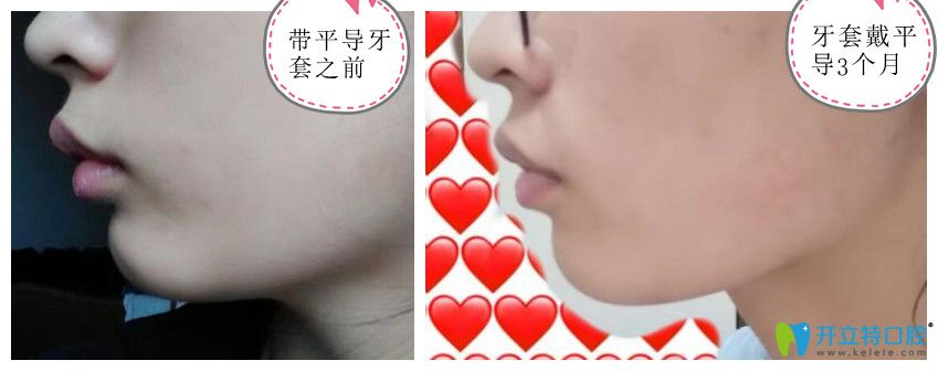 牙齒矯正戴平導(dǎo)3個(gè)月前后對(duì)比照