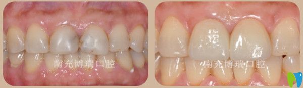 瓷貼面修復(fù)前后對比圖