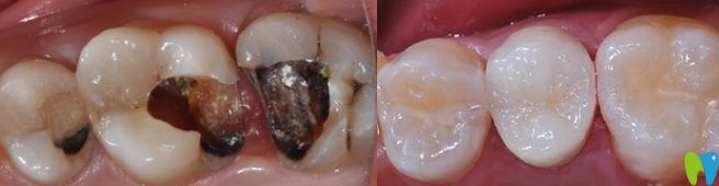 南昌安植雅口腔萬威醫(yī)生根管治療案例