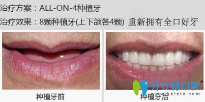 南昌安植雅口腔潘建廷醫(yī)生全口種植牙案例