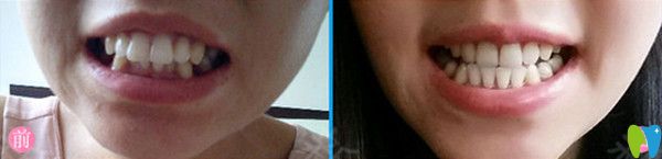 牙齒矯正前后對(duì)比圖 牙齒矯正前后對(duì)比圖