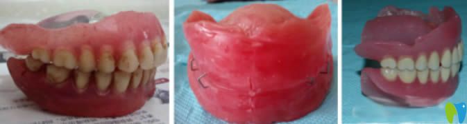 舌側(cè)集中頜排牙后的對(duì)比照片