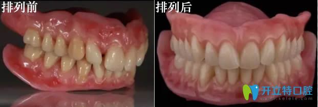 舌側(cè)集中頜全口義齒病例對(duì)比圖