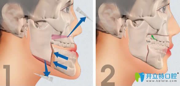 正畸正頜聯(lián)合治療費(fèi)用貴高嗎