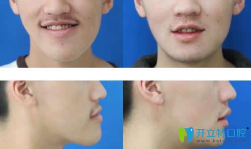 反頜正畸正頜聯(lián)合治療前后對(duì)比照片