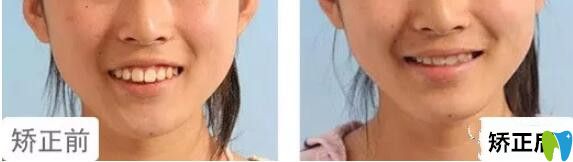 格倫菲爾口腔水平如何？14女孩上牙前突矯正<span style=