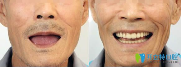 泉州維樂謝燕峰醫(yī)生3D數(shù)字導(dǎo)板全口種植牙對比效果