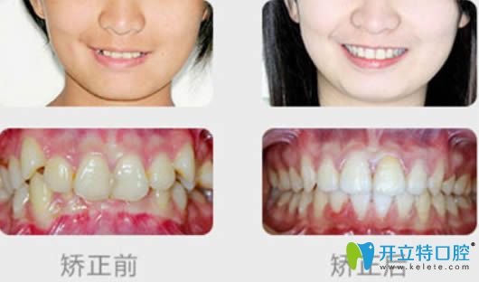 泉州維樂黃鴻進醫(yī)生成人牙齒擁擠矯正前后對比效果