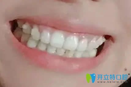我在漯河舒適美口腔做牙齒矯正1年效果