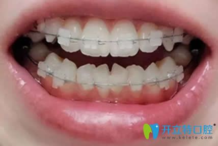 我在漯河舒適美口腔做陶瓷托槽牙齒矯正第3個(gè)月
