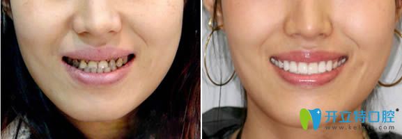 讓嚴(yán)琪醫(yī)生做完牙齒美容瓷貼面的前后對(duì)比照