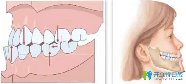聊聊有關(guān)正畸正頜聯(lián)合治療的那些事兒！