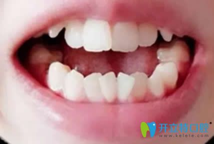 正畸拯救了錯亂牙齒,附我在漯河舒適美口腔牙齒矯正變化照