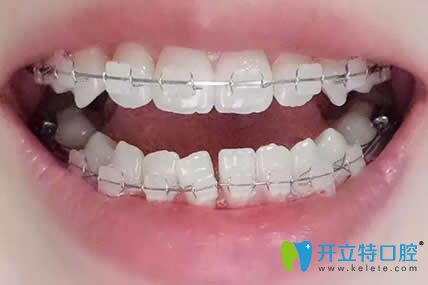 我在漯河舒適美口腔做牙齒矯正戴牙套第9個(gè)月