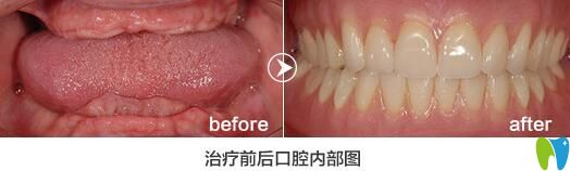 格倫菲爾口腔怎么樣？老年人全口牙缺失種植<span style=