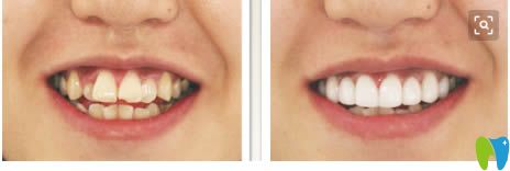 嚴(yán)琪醫(yī)生成人牙齒擁擠不齊矯正案例及前后對(duì)比效果