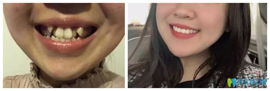 杭州牙齒矯正哪里好？艾芳口腔牙齒擁擠不齊矯正對比圖公布