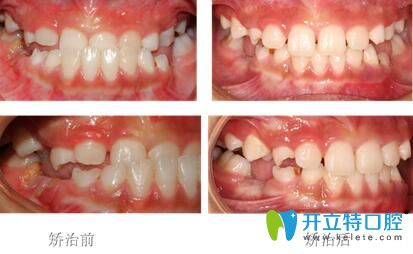 兜齒矯正前后對比圖