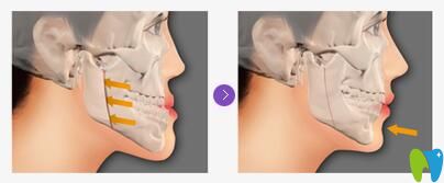 兜齒和地包天的區(qū)別