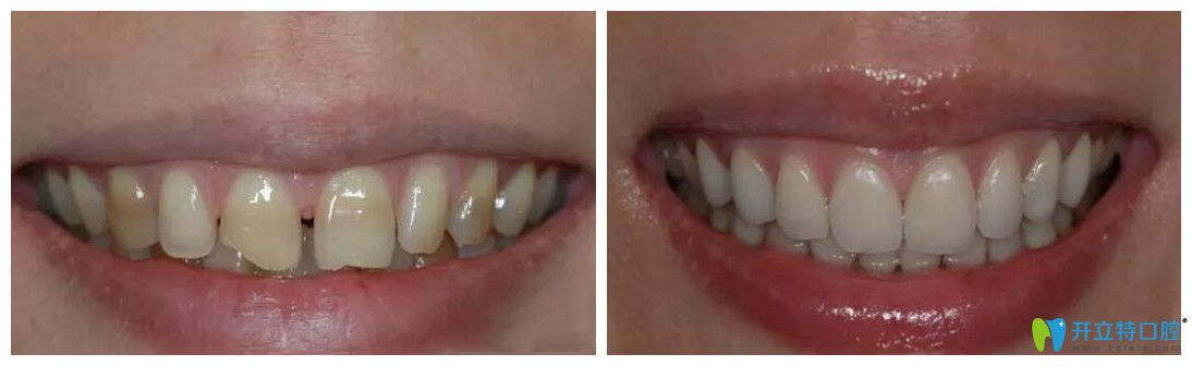 杭州艾芳口腔四環(huán)素牙修復(fù)案例